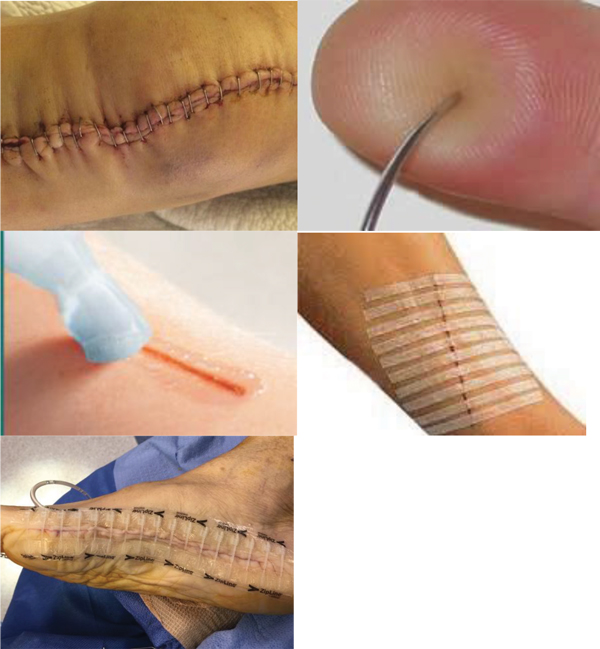 Surgical Staples vs Stitches